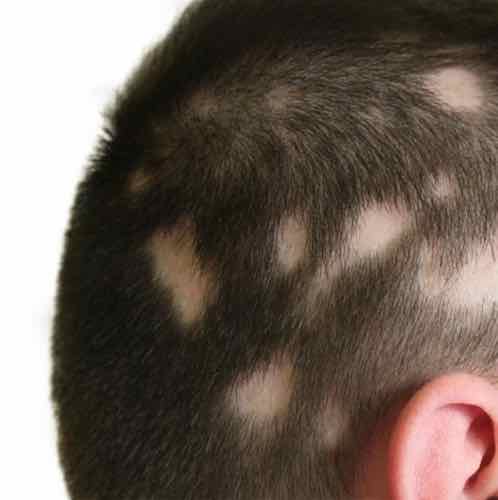 Alopecia