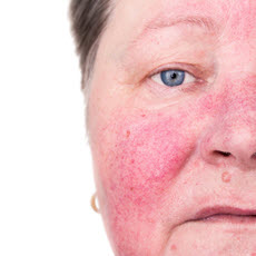 Rosacea